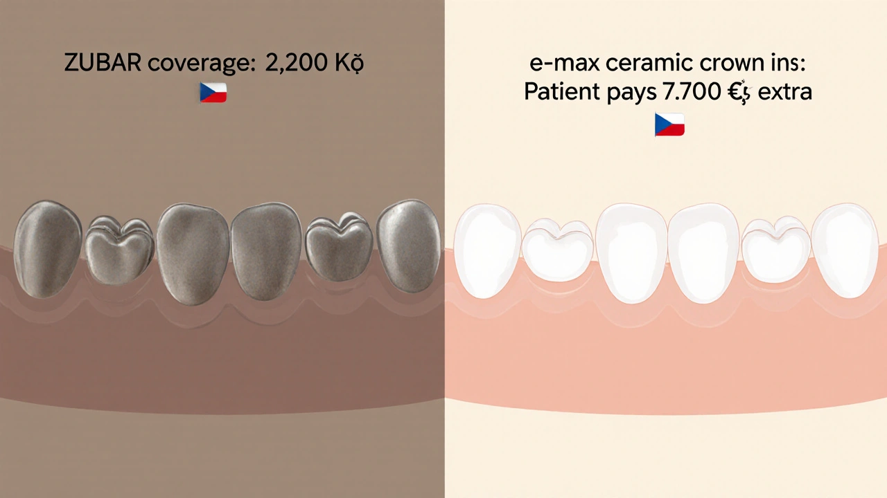 Porovnání kovové a e-max korunky s označením částek, které zaplatí pojišťovna a pacient.