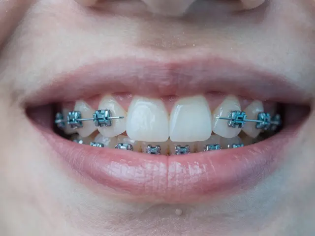 Jak obnovit zničené zuby po rovnátkách: 5 praktických kroků