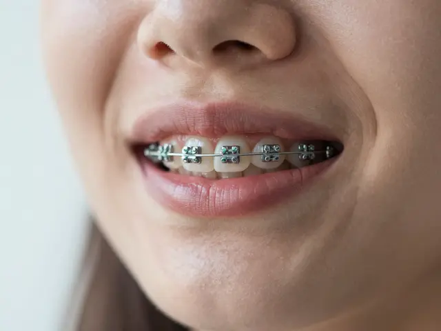 Jak přežít první týden s rovnátky: Praktický průvodce pro nováčky